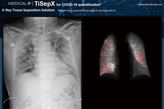 지난해 무료로 배포한 메디컬아이피의 ‘티셉(TiSepX)’. 왼쪽의 엑스레이 사진을 인공지능으로 분석해, 폐의 코로나19 감염 정도를 세밀하게 보여준다. 사진 메디컬아이피