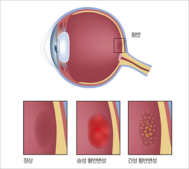 망막에서 초점이 맺어지는 곳에 있는 황반에는 시세포와 시신경이 집중되어 있다. 눈으로 들어온 빛에너지를 전기 신호로 바꾸어 대뇌의 시각 피질로 보내주는 역할을 한다. 사진 아주대학교