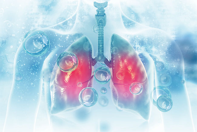 특발성폐섬유화증, 알 수 없는 원인으로 만성염증세포들이 폐에 침범하면 간질이 딱딱해지는 질환을 칭한다.