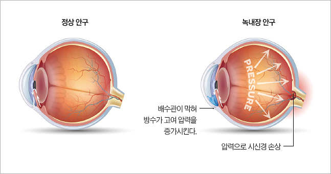 정상인의 안구와 녹내장 환자의 안구. 사진 서울대병원