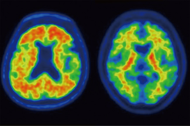 왼쪽부터 양전자 단층 촬영(PET) 검사를 통해 알츠하이머 또는 기타 질환 소견을 받은 뇌 영상과 정상 소견을 받은 뇌 영상. 사진 강북삼성병원