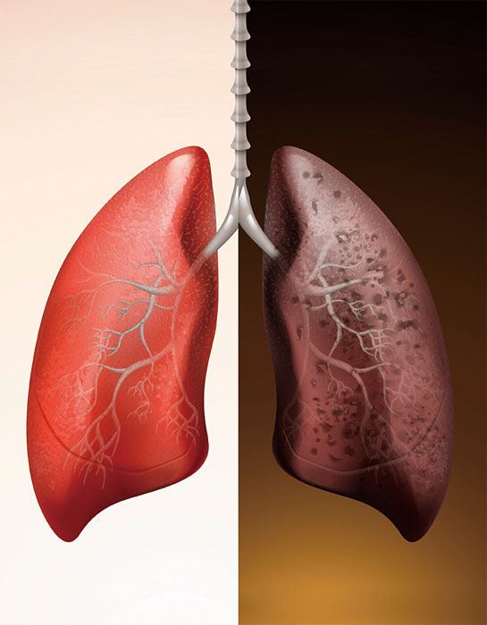 건강한 폐(왼쪽)와 종양이 발병한 폐. 사진 삼성서울병원