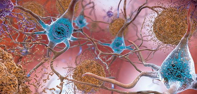 알츠하이머 환자의 뇌 내부를 보여주는 일러스트. 신경세포 사이에 베타 아밀로이드 단백질이 뭉쳐 덩어리를 이뤘고(갈색), 안에는 타우 단백질이 엉켜 있다(파란색). 미국 바이오젠과 일본 에자이의 신약은 베타 아밀로이드 덩어리를 없애 알츠하이머 환자의 인지 기능 감퇴를 억제했다. 사진 NIH