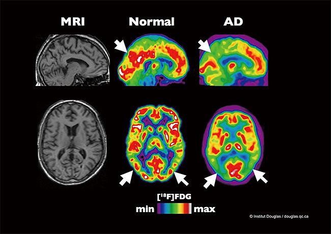 일반인(가운데)과 알츠하이머 환자(오른쪽)의 뇌 영상 차이. 컬러로 나온 양전자방출단층촬영(PET) 사진에서 붉은색은 신경세포 활동이 활발한 곳을 의미한다. 알츠하이머 환자의 뇌에서 신경세포 활동이 크게 줄어든 것을 볼 수 있다. 사진 Flickr