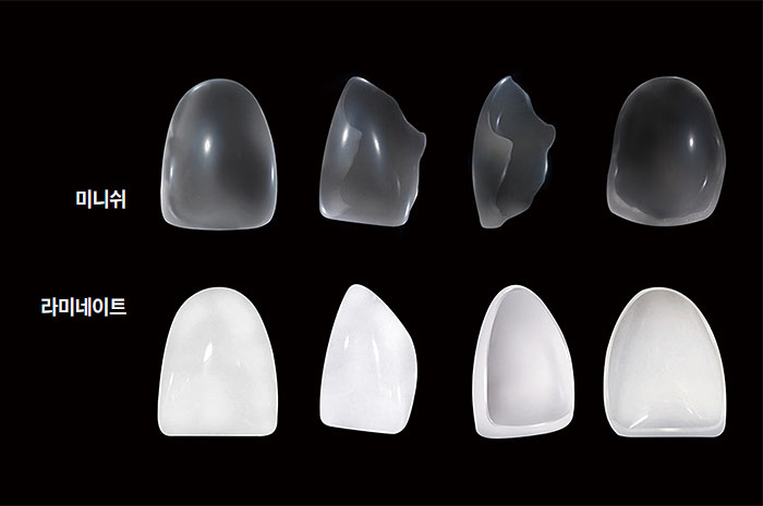 치아 모양 맞춤과 투명도 조절이 가능한 미니쉬와 기존 보철물 라미네이트. 사진 미니쉬테크놀로지