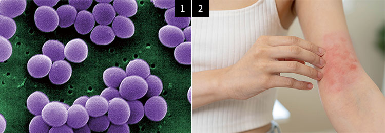 1 황색포도상구균(staphylococcus aureus)의 전자현미경 사진. 사진 미 질병통제예방센터
2 미 하버드대 의대 연구진은 황색포도상구균이 신경세포에 직접 작용해 가려움증을 유발한다는 사실을 처음으로 밝혀냈다. 사진 셔터스톡