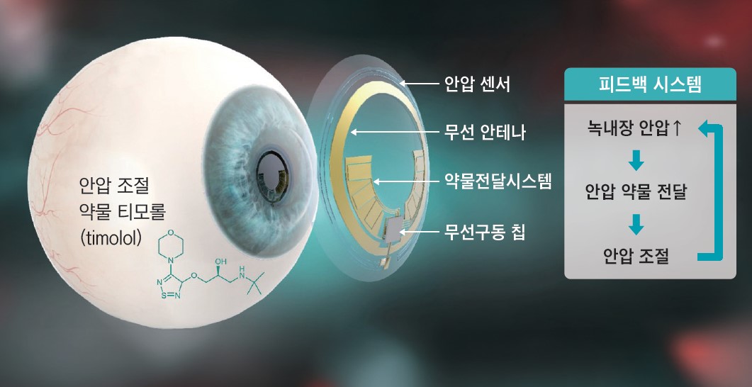 녹내장 환자의 안압 모니터링 및 안압 조절 약물 전달 피드백 시스템 모식도. /포스텍