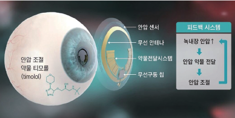 화이바이오메드가 개발한 진단·치료 겸용 스마트
콘택트렌즈. /사진 화이바이오메드