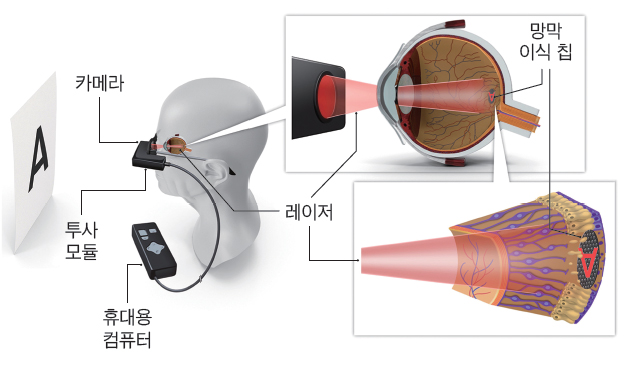 전자 눈 프리마 장치. 안경 카메라가 사물을 보면 휴대용 컴퓨터가 처리해서 해당 정보를 레이저로 망막에 이식한 칩에 보낸다. 칩은 빛을 전기신호로 바꿔 영국 임상시험 참가자가 전자 눈 프리마 장치로 시력 재활 훈련을 받고 있다. 뇌로 보내 사물을 인식하도록 한다. / 미국 스탠퍼드대