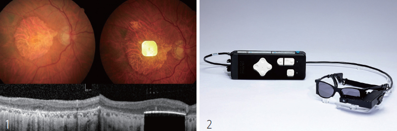 1 진행성 노인성 황반변성(AMD)으로 망막 시세포가 손상된 눈(왼쪽)과 시세포 기능을 대신하는 전자 칩을 이식한 환자의 눈(오른쪽). 2 칩을 눈에 이식한 환자가 착용하는 안경 카메라와 휴대용 컴퓨터. 사이언스 코퍼레이션