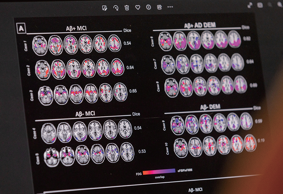 알츠하이머병 환자의 뇌 사진. ／ 로이터뉴스1