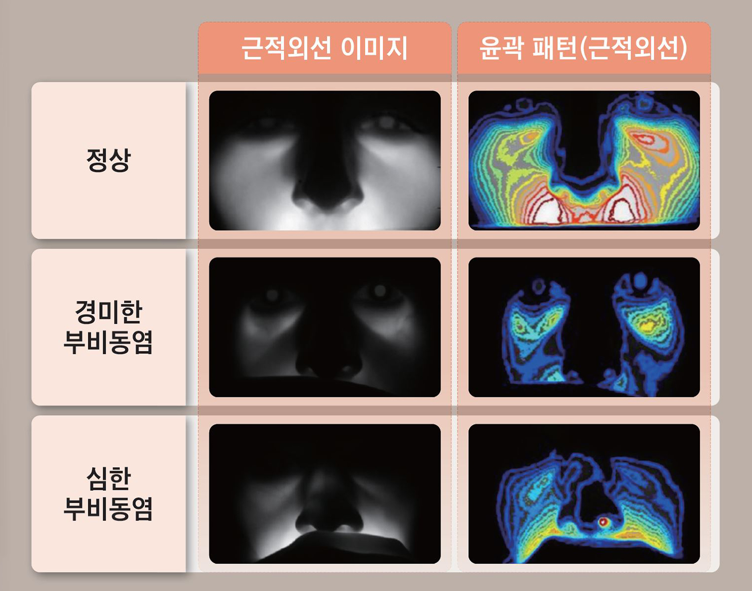 사이너스뷰가 포착한 부비동염. 근적외선에 AI 패턴 인식
모듈을 결합해 진단 정확도를 높였다. /사진 유투메드텍